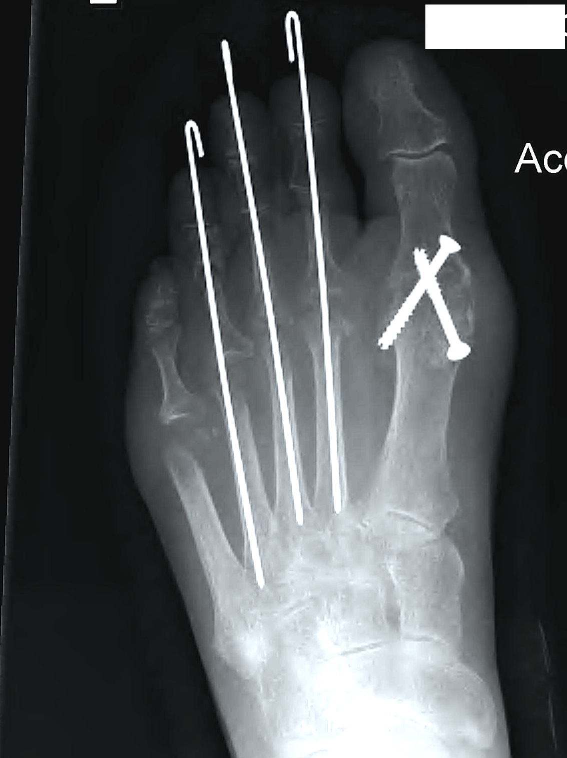 Rheumatoid Forefoot Fowlers MTPJ Fusion